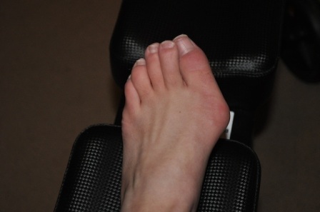 foot-before-surgery.jpg
