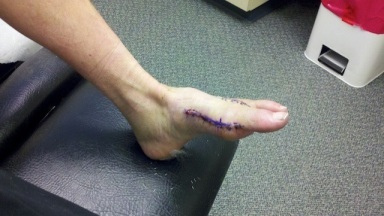 foot-with-incision.jpg
