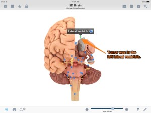 Diagram of the brain showing where Renee's tumor was